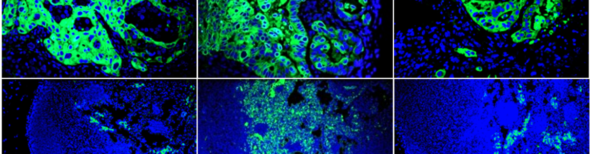 Cholangiocarcinoma growth and lymph nodes infiltration in mouse xenograft model