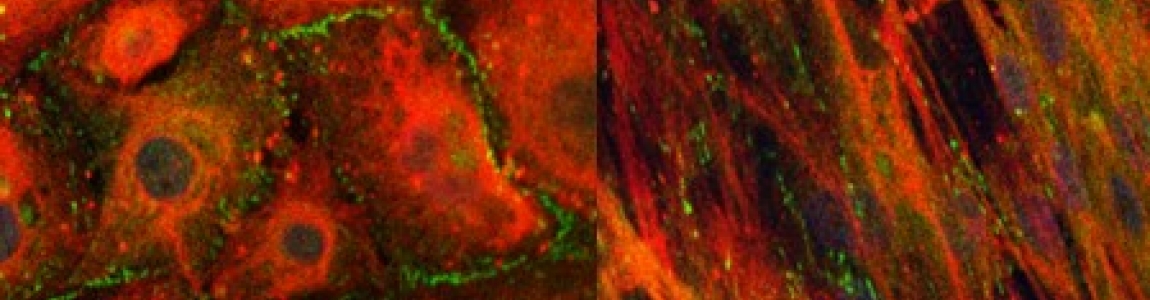 Immunofluorecence showing primary mesothelial cells in an epithelial like state (left) and in a mesenchymal-like state (right) after treatment with TGFbeta