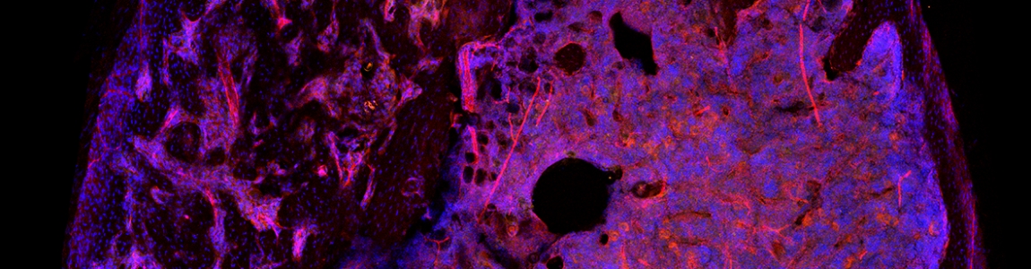 FD lesion in transgenic mouse femur